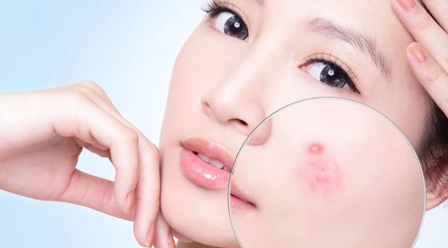 Lưu Huỳnh Trị Mụn